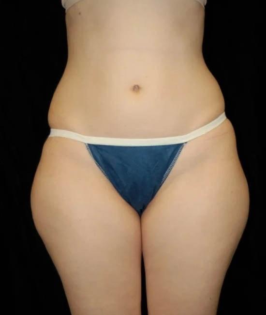Liposuction before at Gary Motykie, MD in West Hollywood, CA