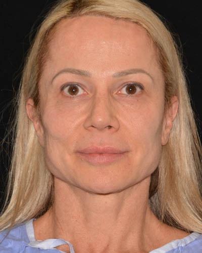 Facelift before at Gary Motykie, MD in West Hollywood, CA