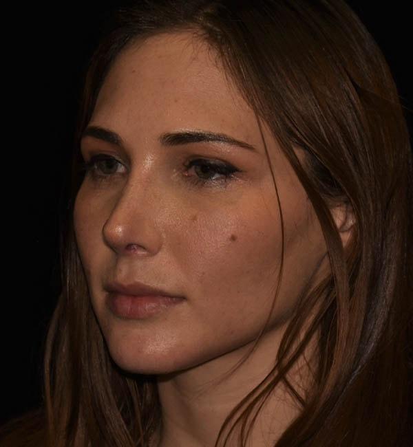 Rhinoplasty after at Gary Motykie, MD in West Hollywood, CA