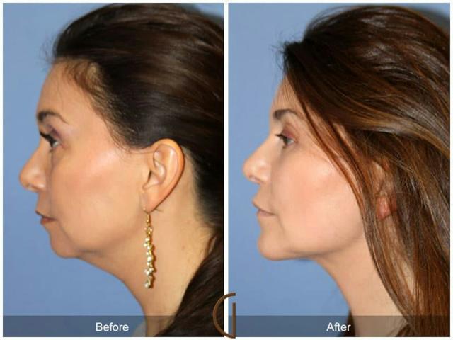 Fat Transfer result at Dr. Kevin Sadati in Newport Beach, CA