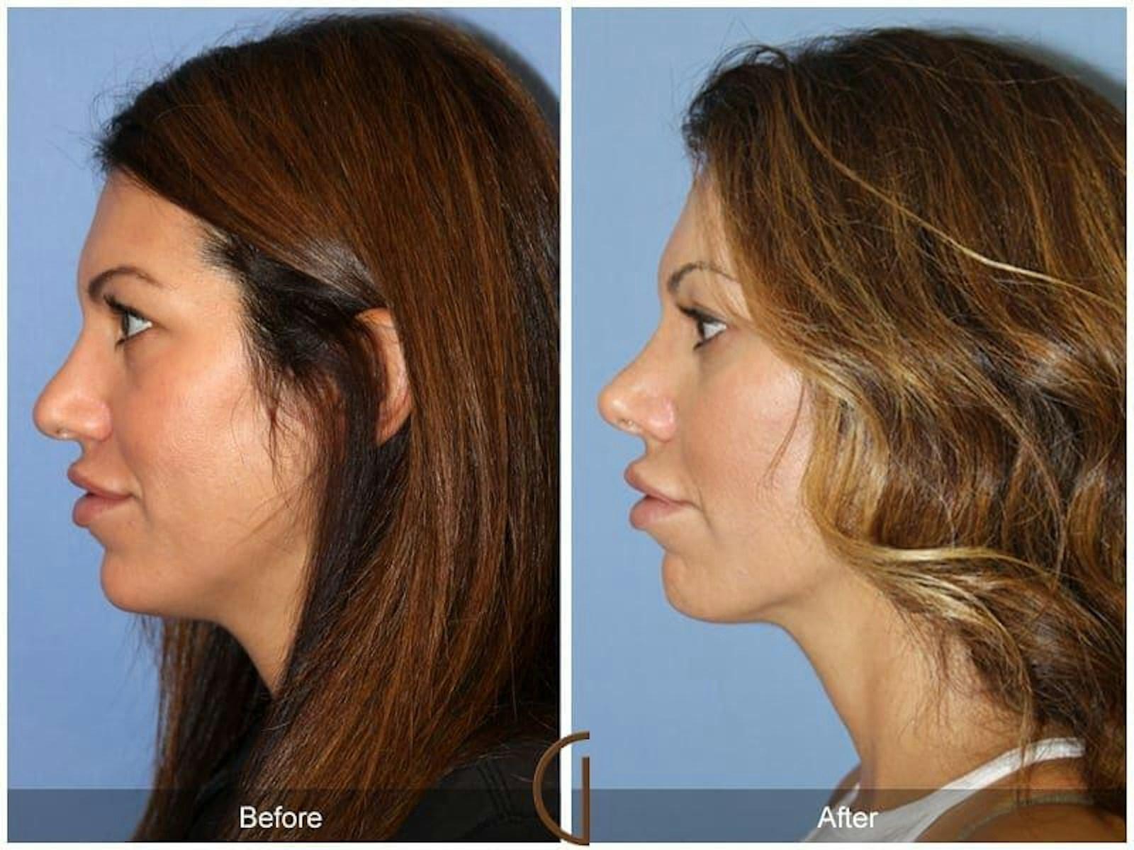 Dr. Kevin Sadati rhinoplasty result — Newport Beach, CA