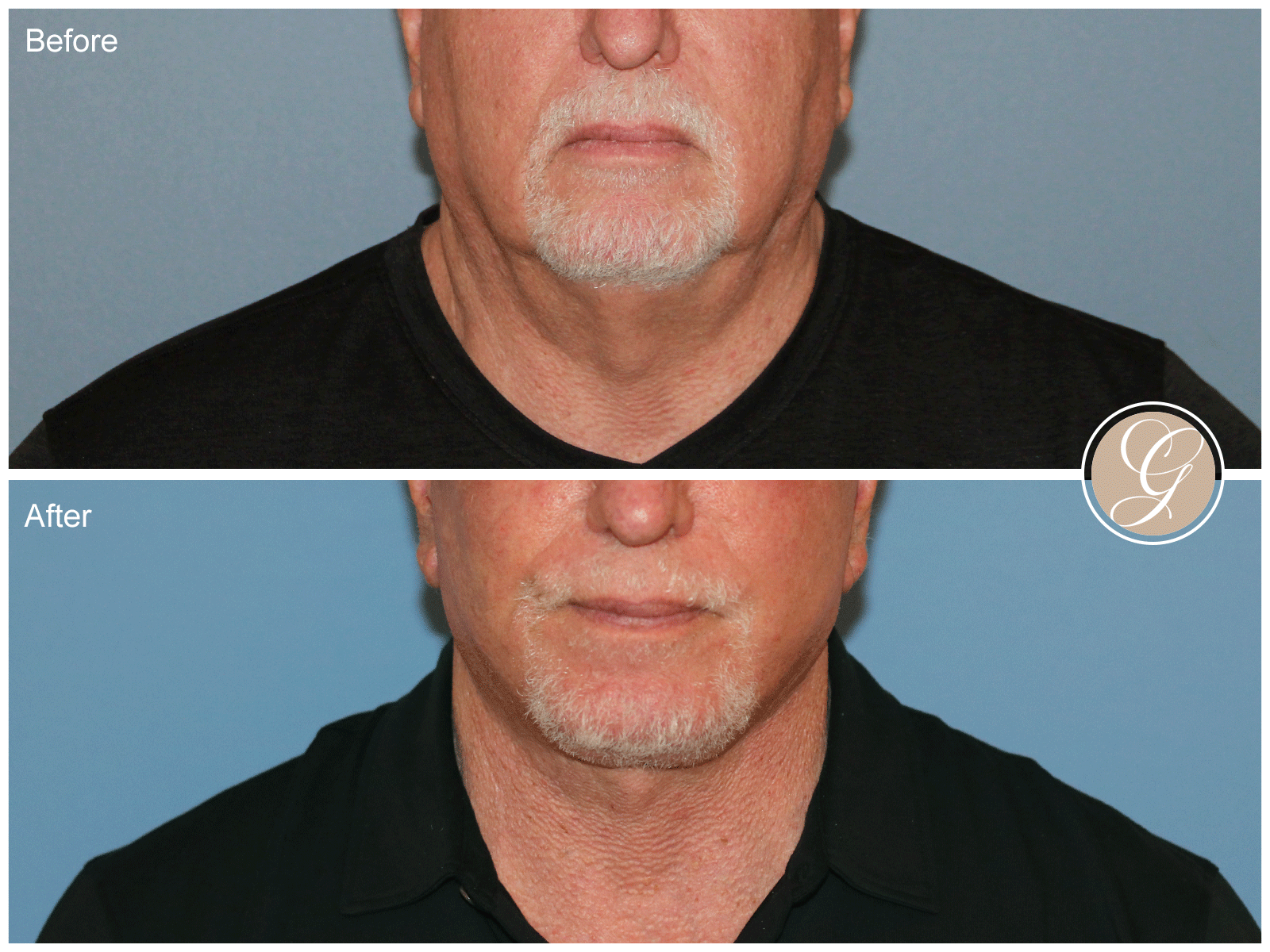 Orange County Facial Plastic Surgeon result — Newport Beach, CA