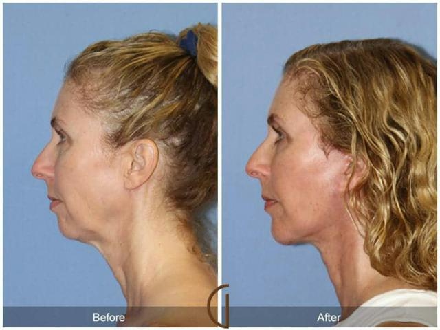 Chin Implant result at Dr. Kevin Sadati in Newport Beach, CA
