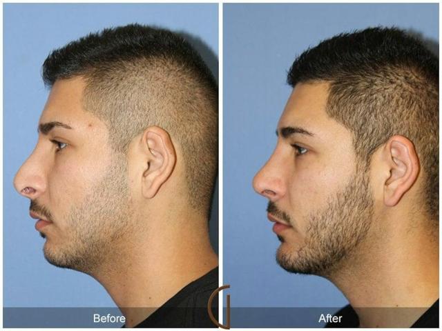 Chin Implant result at Dr. Kevin Sadati in Newport Beach, CA