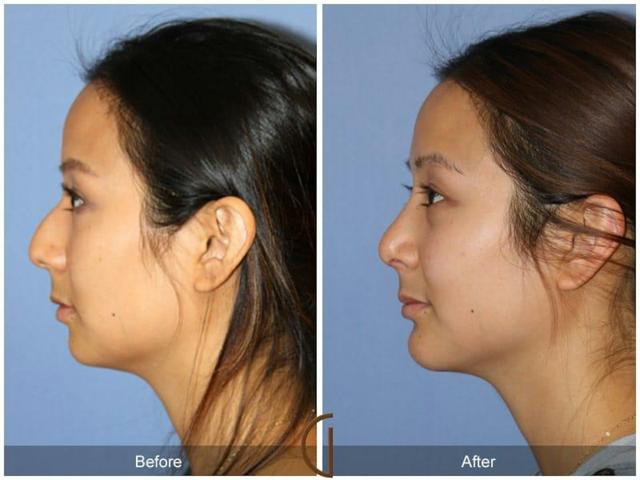 Chin Implant result at Dr. Kevin Sadati in Newport Beach, CA