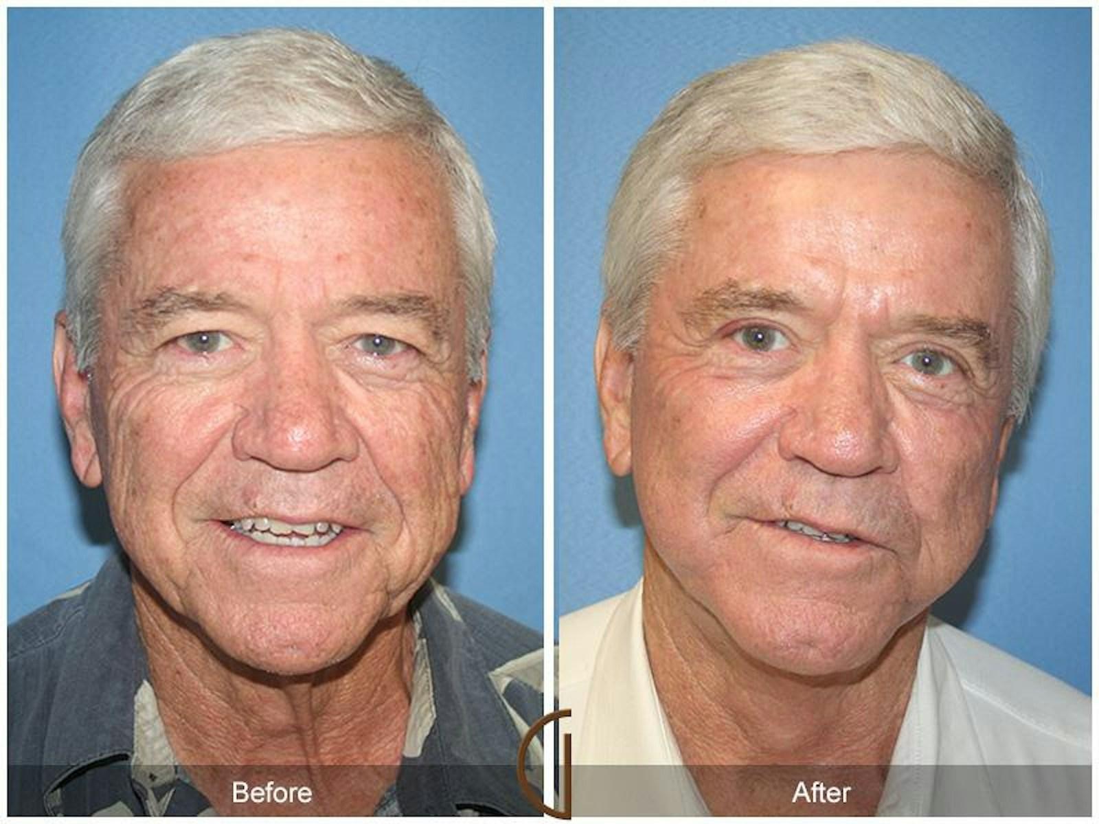 Dr. Kevin Sadati facelift result — Newport Beach, CA