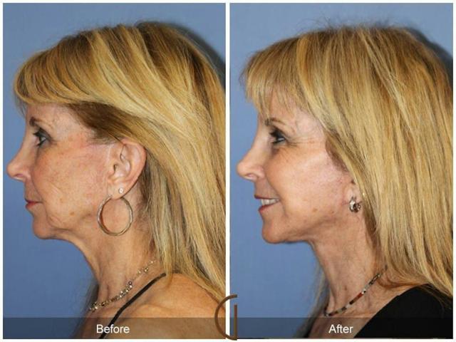 Fat Transfer result at Dr. Kevin Sadati in Newport Beach, CA