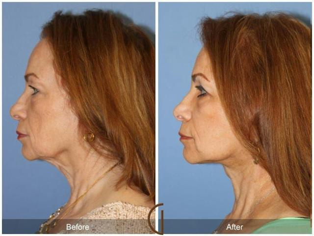 Fat Transfer result at Dr. Kevin Sadati in Newport Beach, CA