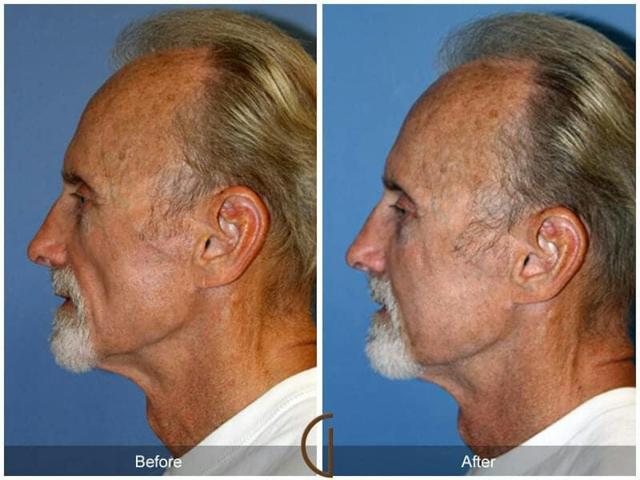 Fat Transfer result at Dr. Kevin Sadati in Newport Beach, CA