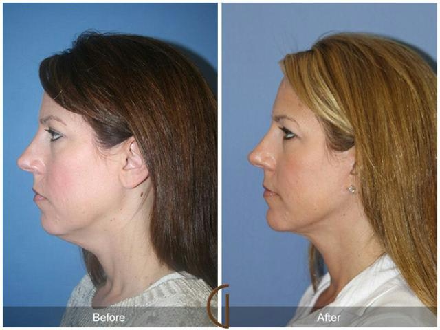Neck Lift result at Dr. Kevin Sadati in Newport Beach, CA