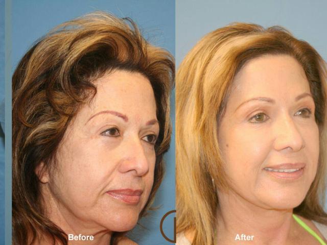 Fat Transfer result at Dr. Kevin Sadati in Newport Beach, CA