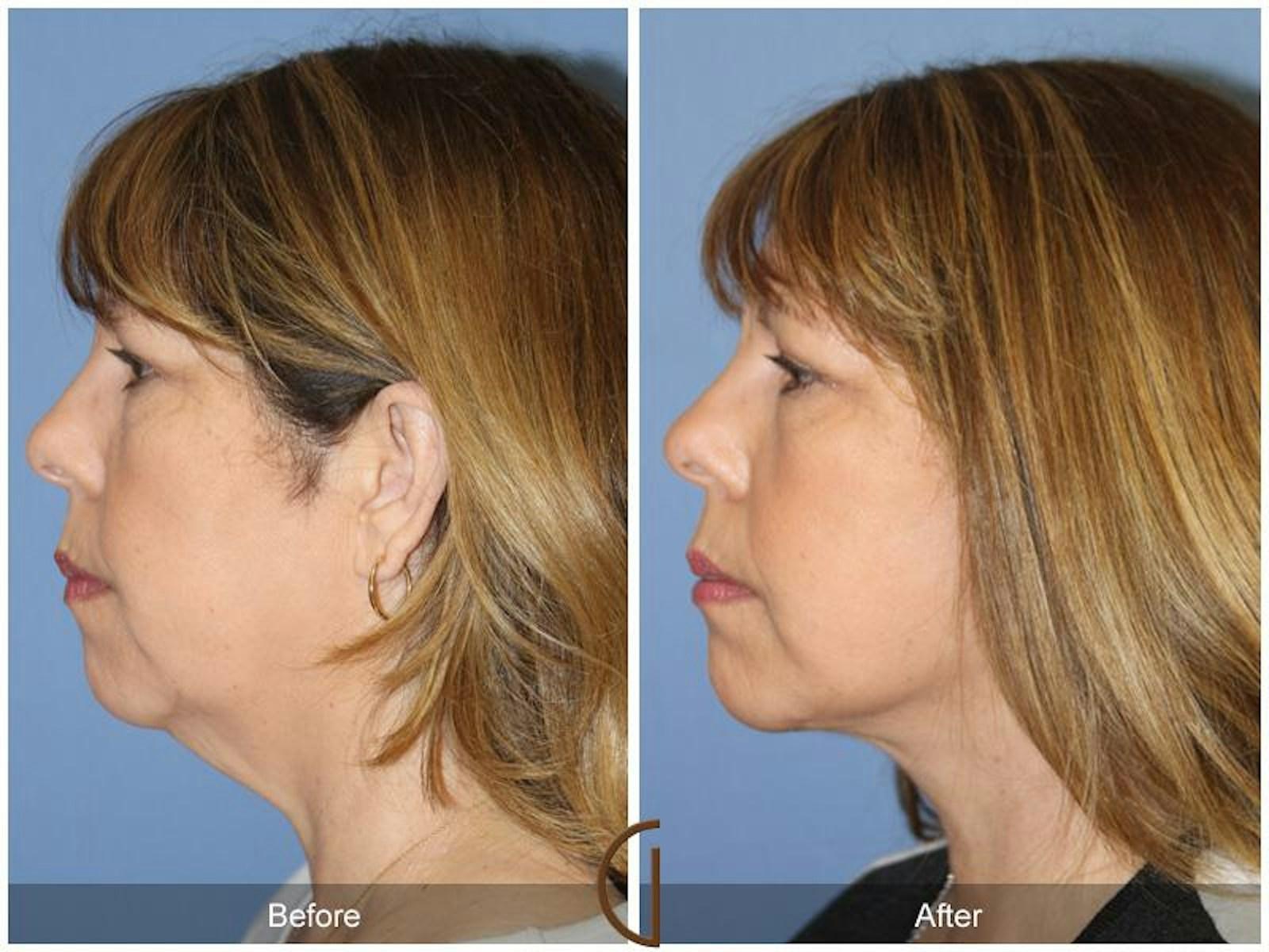Dr. Kevin Sadati neck lift result — Newport Beach, CA