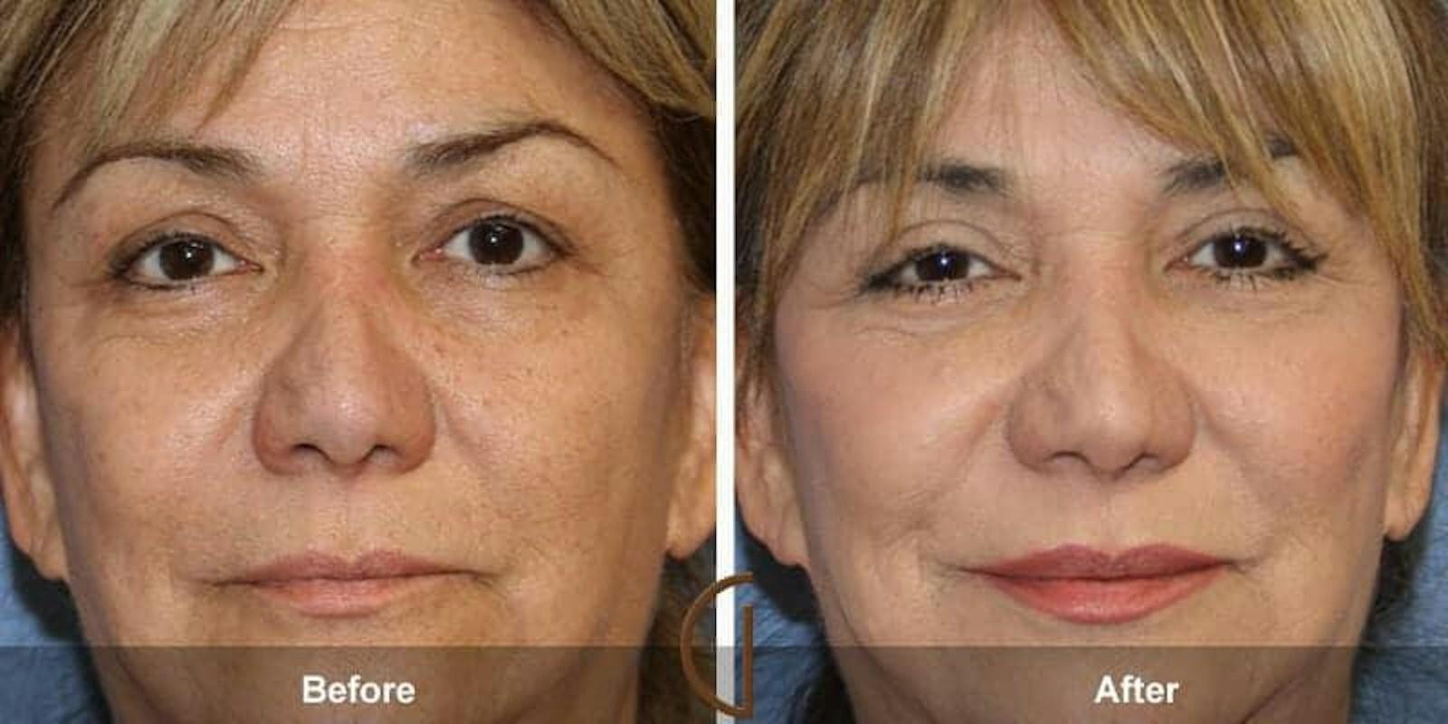 Dr. Kevin Sadati eyelid lift result — Newport Beach, CA