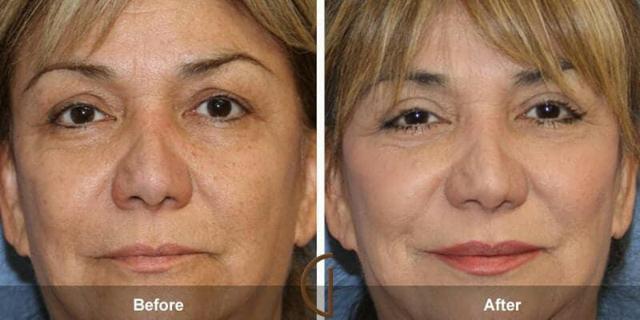 Blepharoplasty result at Dr. Kevin Sadati in Newport Beach, CA