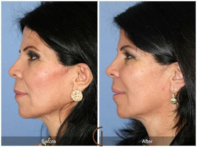 Fat Transfer result at Dr. Kevin Sadati in Newport Beach, CA