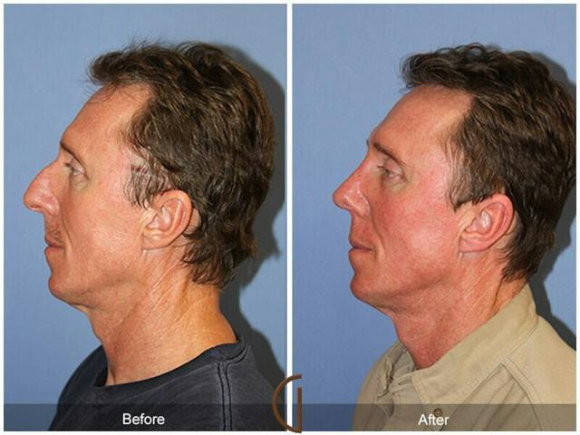Functional Rhinoplasty result at Dr. Kevin Sadati in Newport Beach, CA