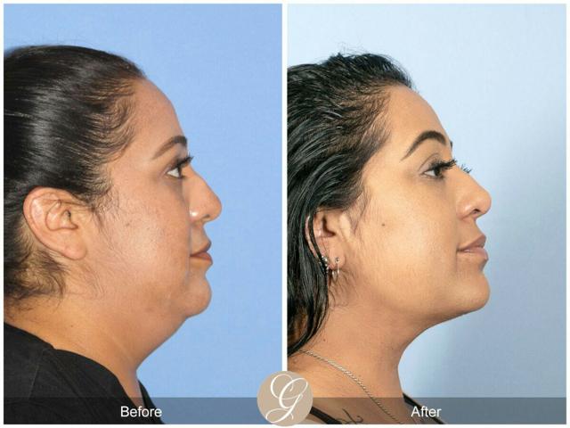 Neck Liposuction result at Dr. Kevin Sadati in Newport Beach, CA