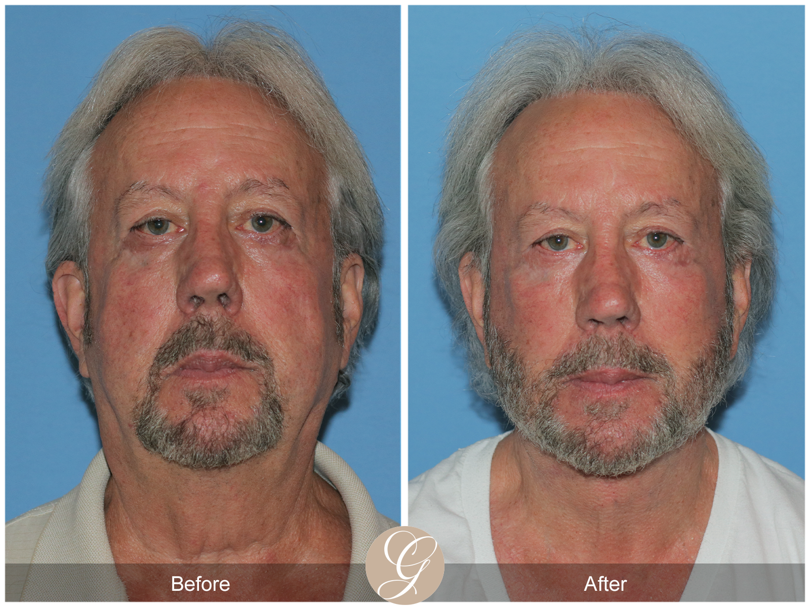 Orange County Facial Plastic Surgeon result — Newport Beach, CA