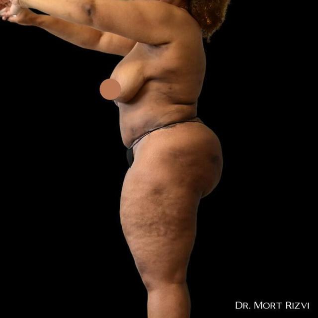 Tummy Tuck after at West Empire Plastic Surgery in Los Angeles, CA