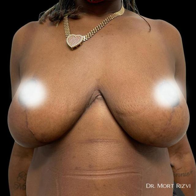 Breast Lift after at West Empire Plastic Surgery in Los Angeles, CA