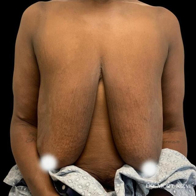 Breast Lift before at West Empire Plastic Surgery in Los Angeles, CA
