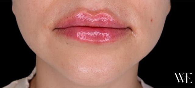 Lip Filler after at West Empire Plastic Surgery in Los Angeles, CA