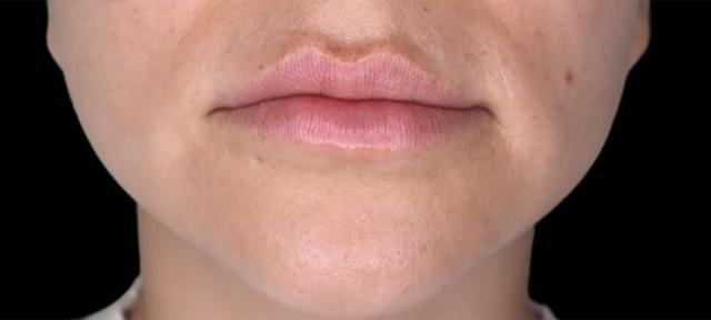 Lip Filler before at West Empire Plastic Surgery in Los Angeles, CA
