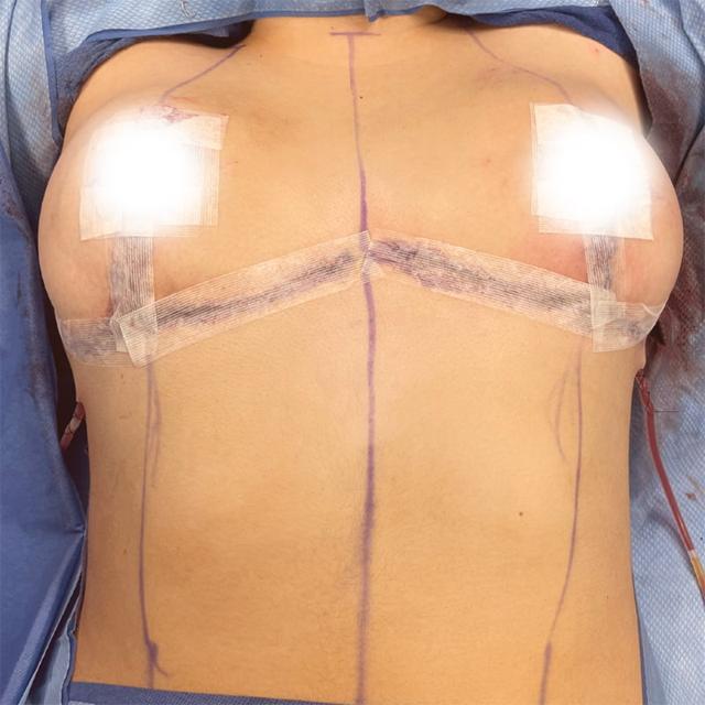 Breast Lift after at West Empire Plastic Surgery in Los Angeles, CA