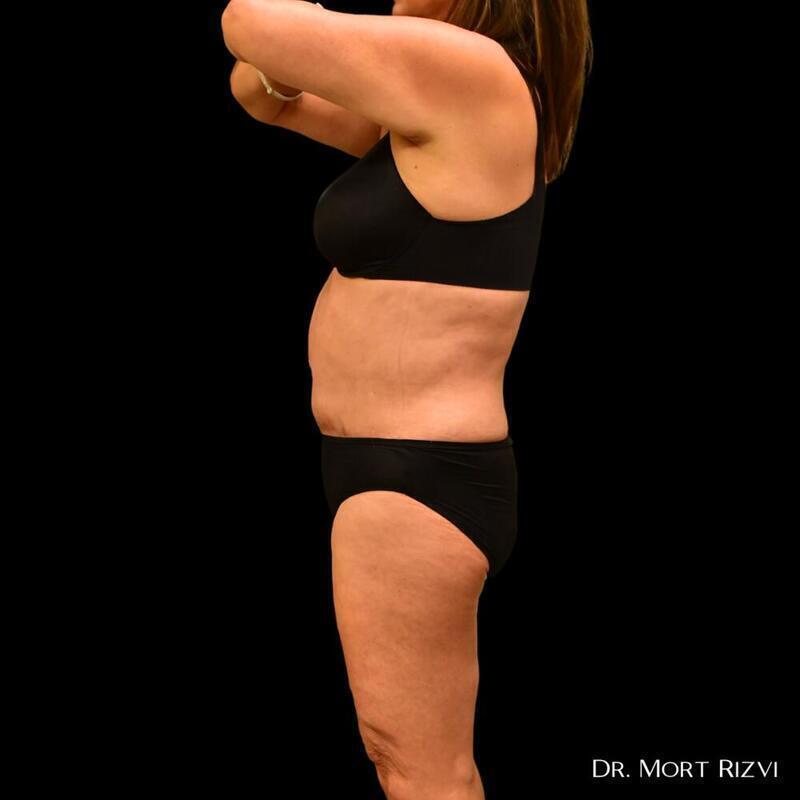 West Empire Plastic Surgery liposuction after — Los Angeles, CA