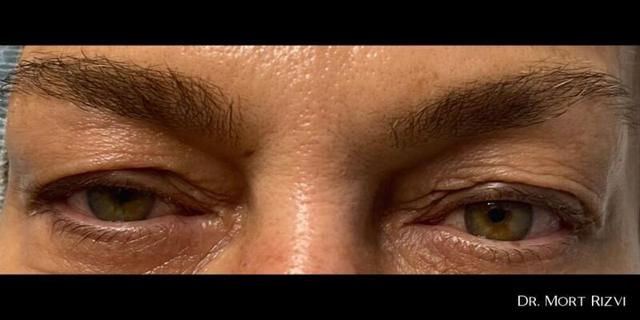 Blepharoplasty before at West Empire Plastic Surgery in Los Angeles, CA