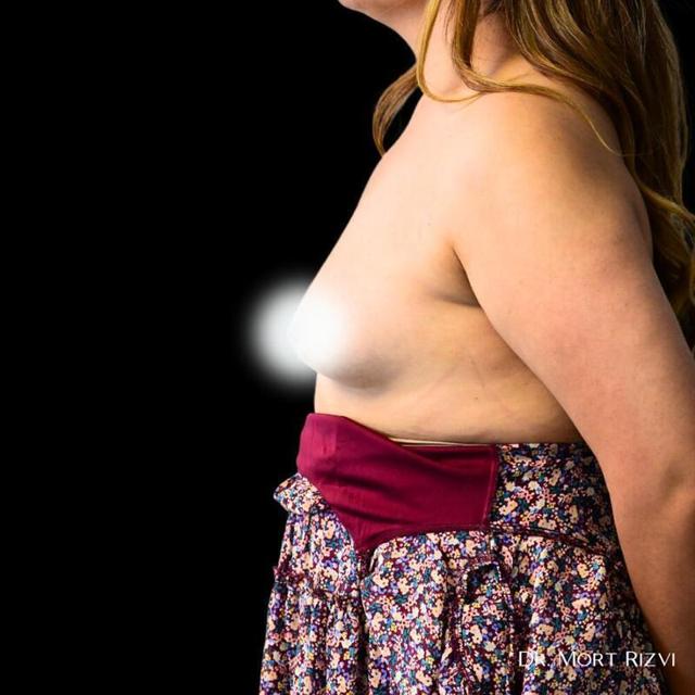 Fat Transfer Breast Augmentation before at West Empire Plastic Surgery in Los Angeles, CA