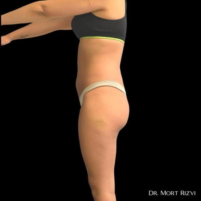 Brazilian Butt Lift before at West Empire Plastic Surgery in Los Angeles, CA