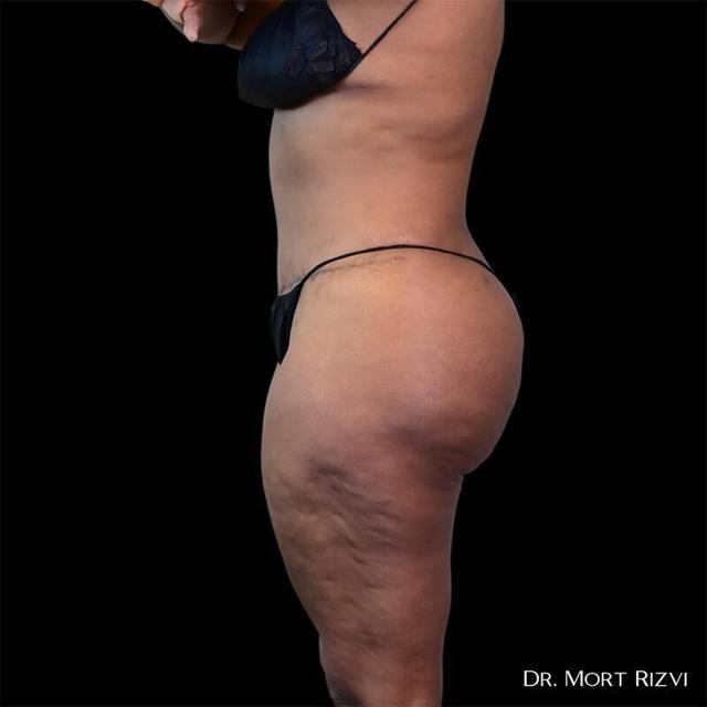 Brazilian Butt Lift after at West Empire Plastic Surgery in Los Angeles, CA