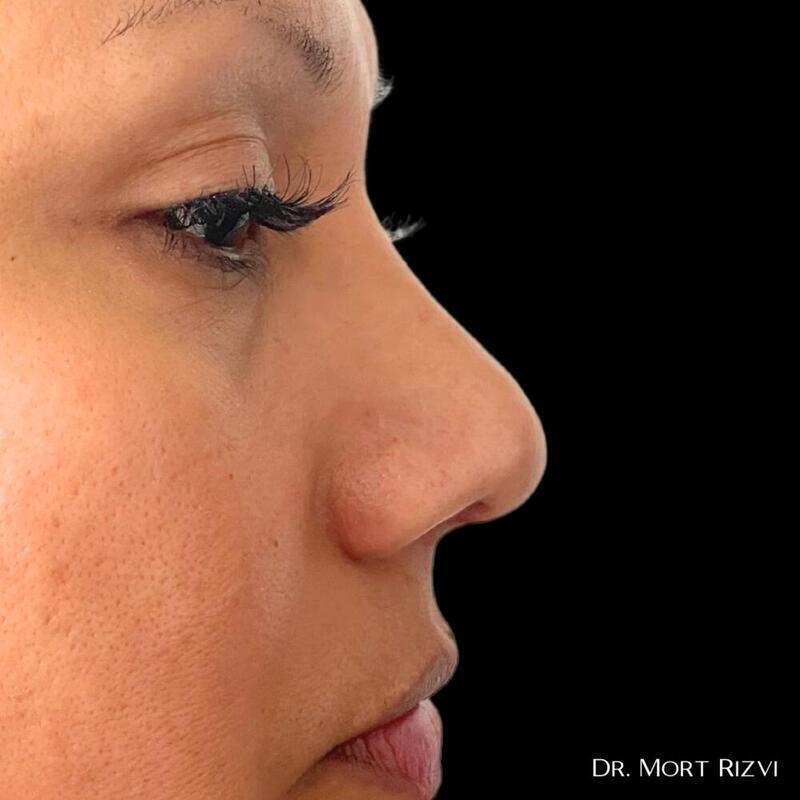 West Empire Plastic Surgery rhinoplasty after — Glendale, CA