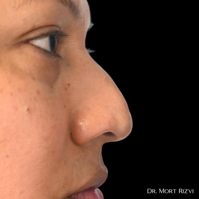 Functional Rhinoplasty before at West Empire Plastic Surgery in Los Angeles, CA