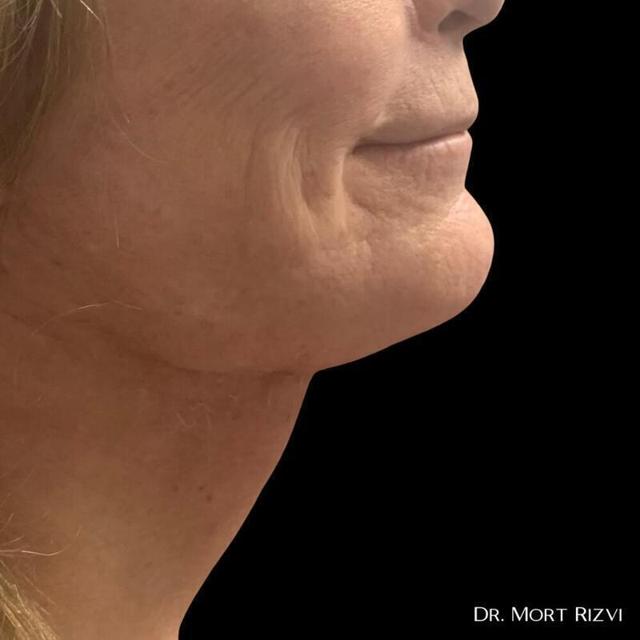 Deep Plane Facelift after at West Empire Plastic Surgery in Los Angeles, CA