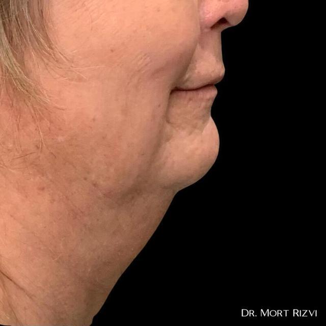 Deep Plane Facelift before at West Empire Plastic Surgery in Los Angeles, CA