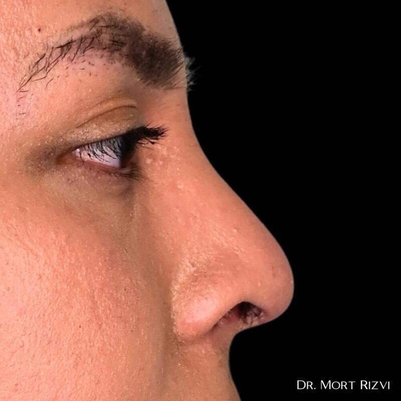 West Empire Plastic Surgery rhinoplasty after — Glendale, CA