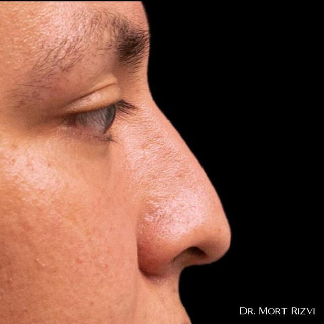 Functional Rhinoplasty before at West Empire Plastic Surgery in Los Angeles, CA