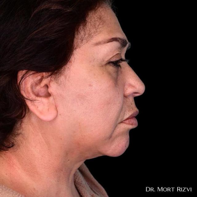 Deep Plane Facelift after at West Empire Plastic Surgery in Los Angeles, CA
