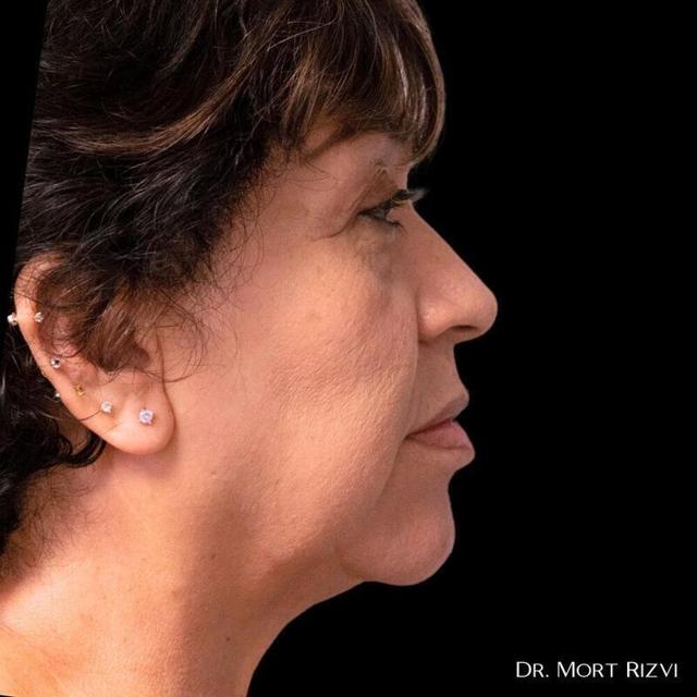 Deep Plane Facelift before at West Empire Plastic Surgery in Los Angeles, CA