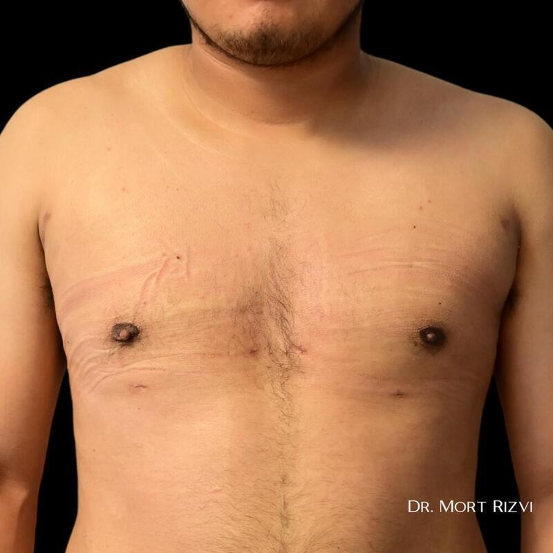 West Empire Plastic Surgery gynecomastia after — Glendale, CA