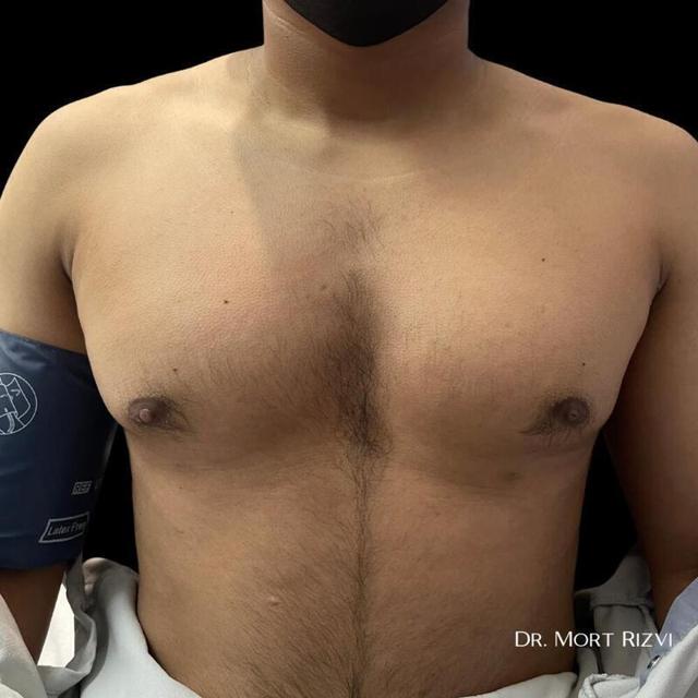 Gynecomastia Surgery before at West Empire Plastic Surgery in Glendale, CA