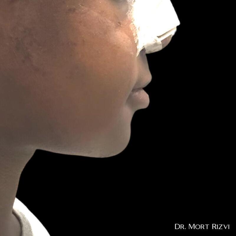 West Empire Plastic Surgery chin implant after — Glendale, CA