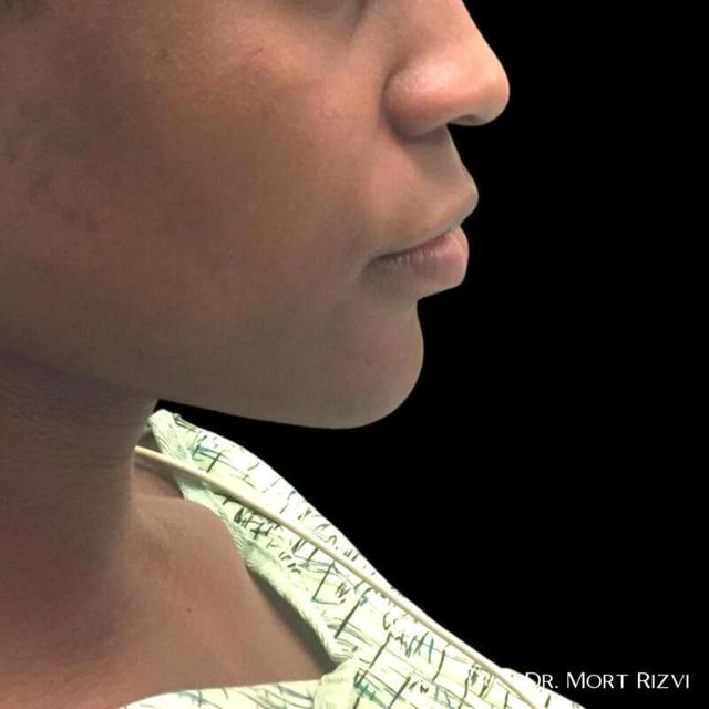 Chin Implant before at West Empire Plastic Surgery in Glendale, CA