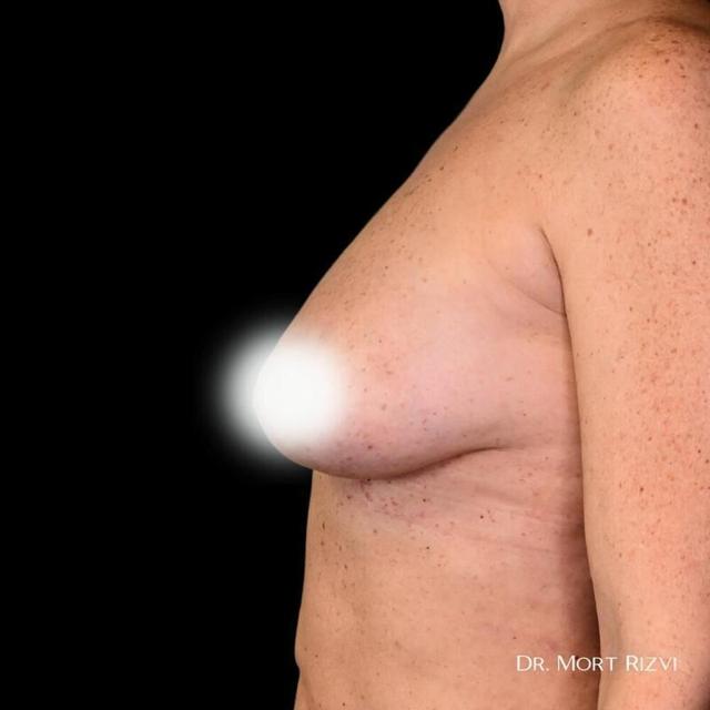 Fat Transfer Breast Augmentation after at West Empire Plastic Surgery in Los Angeles, CA