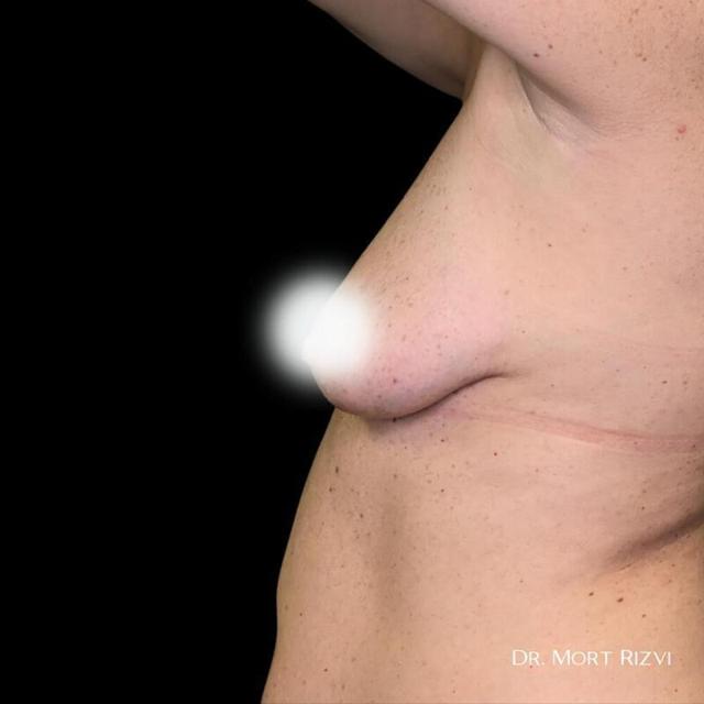 Fat Transfer Breast Augmentation before at West Empire Plastic Surgery in Los Angeles, CA