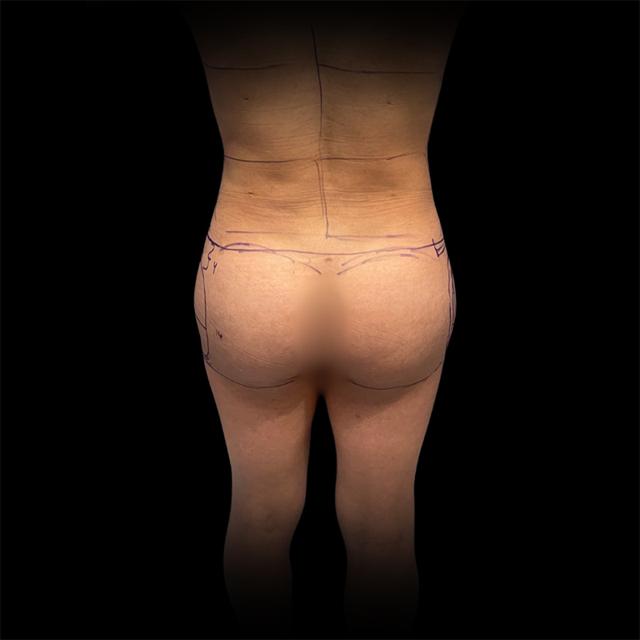 Brazilian Butt Lift before at West Empire Plastic Surgery in Los Angeles, CA