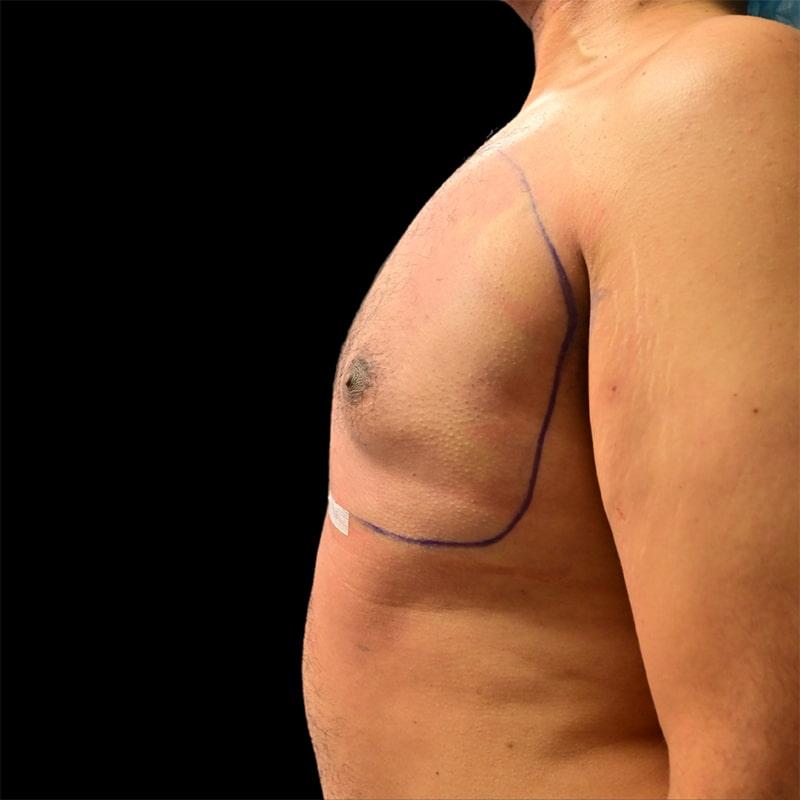 West Empire Plastic Surgery gynecomastia after — Glendale, CA