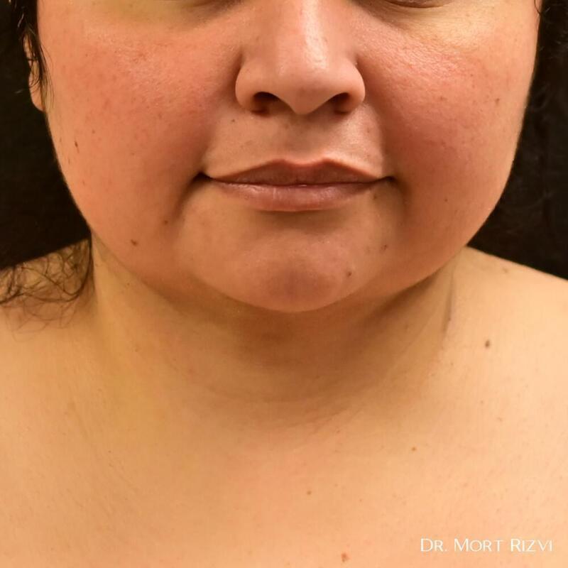 West Empire Plastic Surgery submental liposuction after — Glendale, CA
